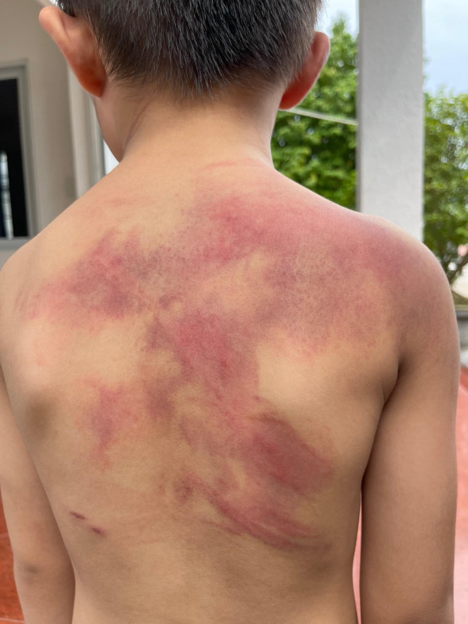 Tạm giữ người cha liên tục bạo hành con trai 5 tuổi