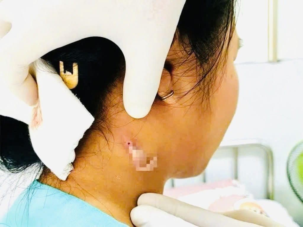 Đồng Nai bất ngờ ghi nhận ca bệnh “vi khuẩn ăn thịt người” Whitmore đầu tiên