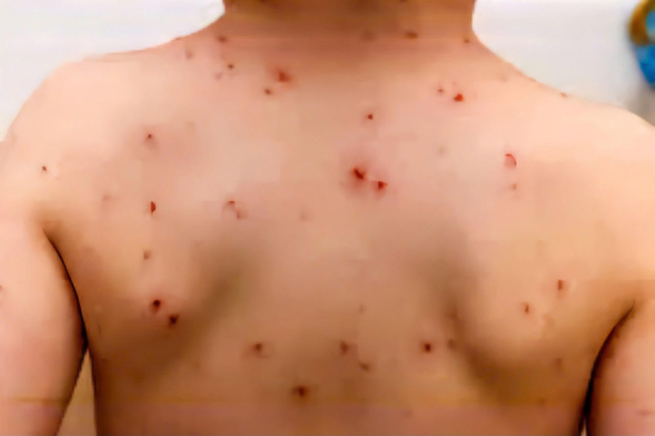 Một bé trai 3 tuổi tử vong nghi do bệnh sởi biến chứng