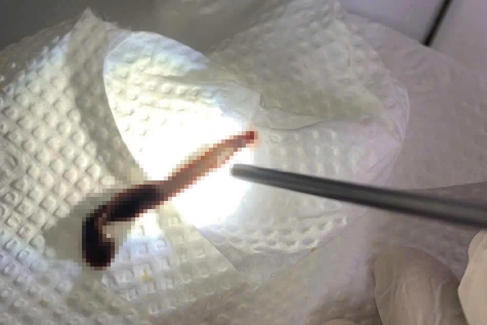 Bị vắt chui vào mũi sau chuyến về quê, người phụ nữ nhập viện khẩn cấp