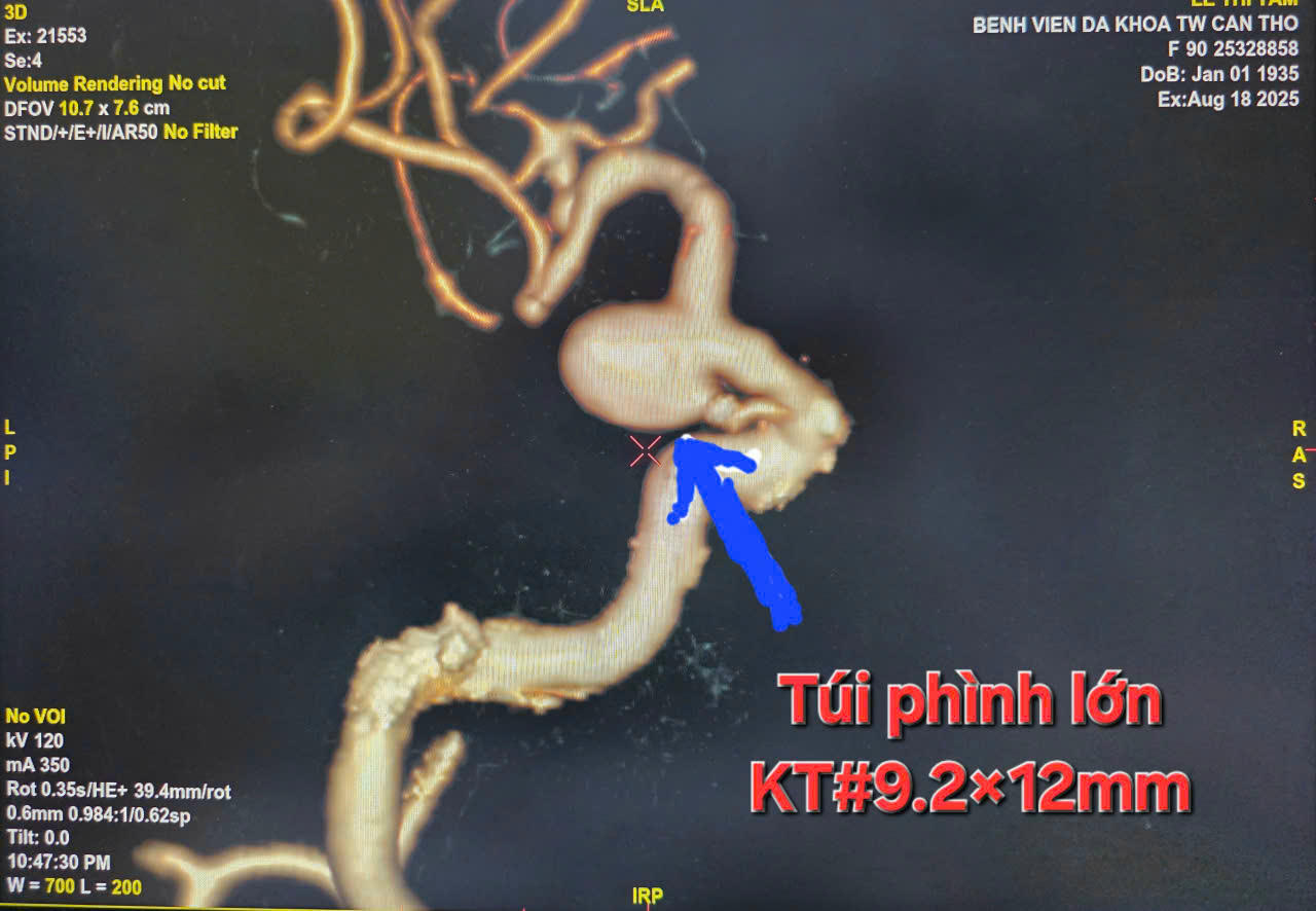 Túi phình mạch máu nảo kích thước lớn trước can thiệp