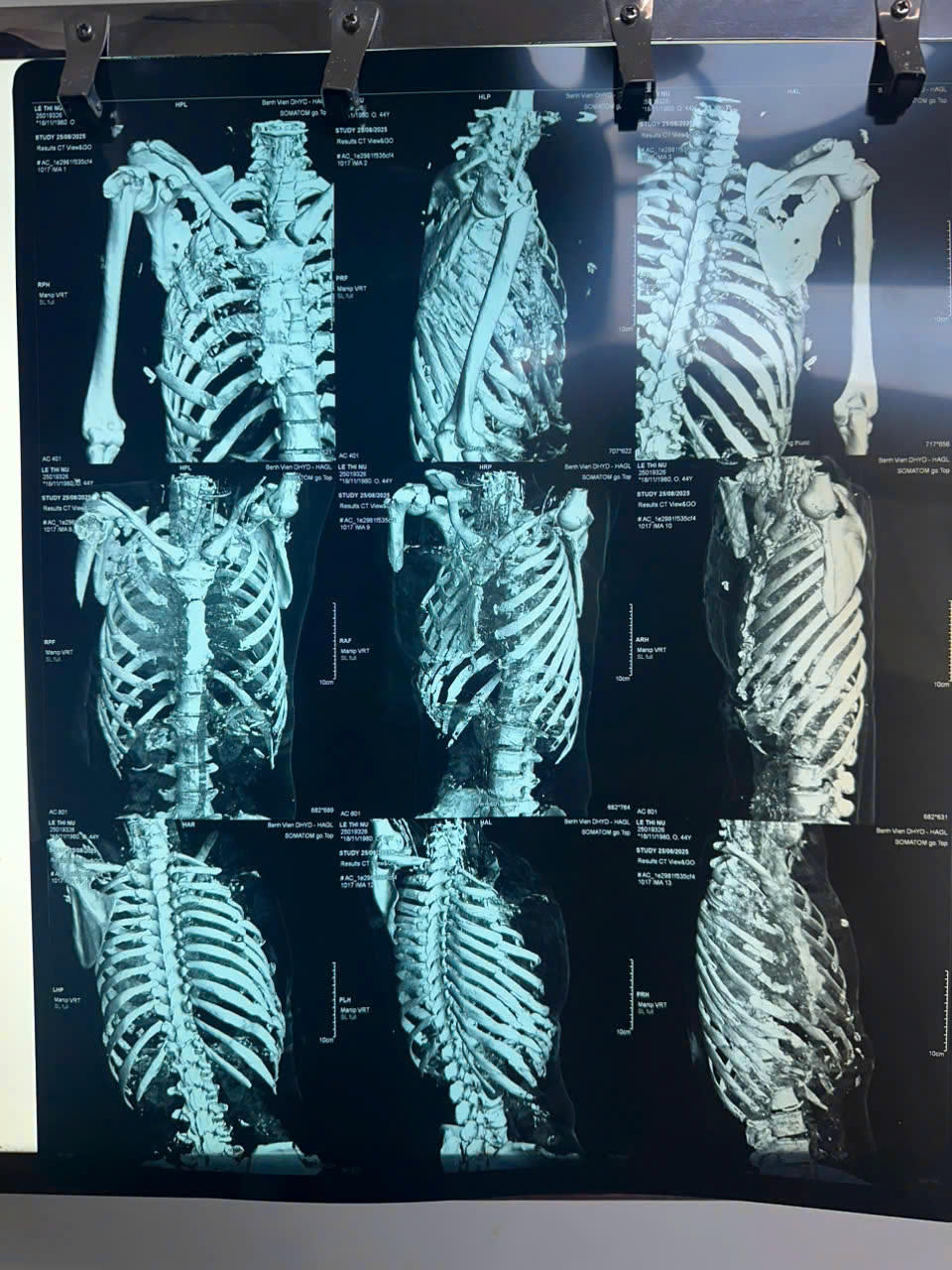 Hình ảnh CT dựng hình.