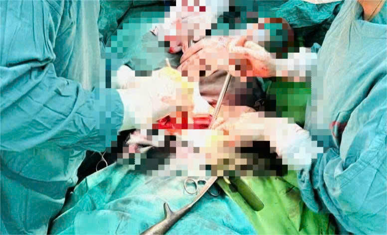 Phẫu thuật, loại bỏ u xơ tử cung có kích thước lớn hiếm gặp cho một bệnh nhân 