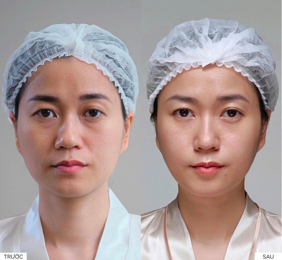 Diễn viên Lâm Vỹ Dạ thay đổi sau liệu trình: da ẩm mịn, cấu trúc săn chắc, thần sắc rạng rỡ  – đánh giá cao sự minh bạch