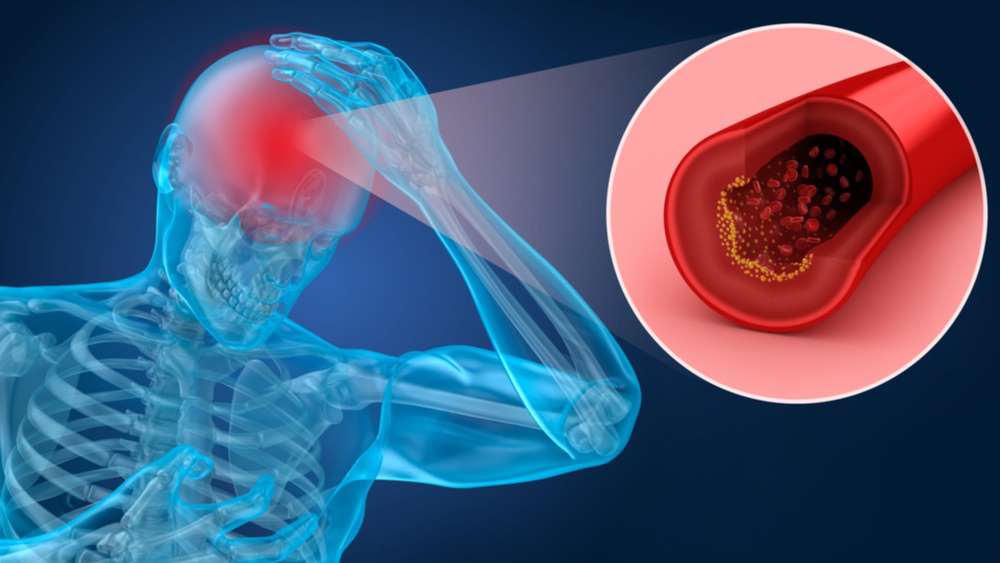 Căng thẳng, thiếu ngủ, ăn uống thất thường khiến hệ mạch máu não bị tổn thương sớm