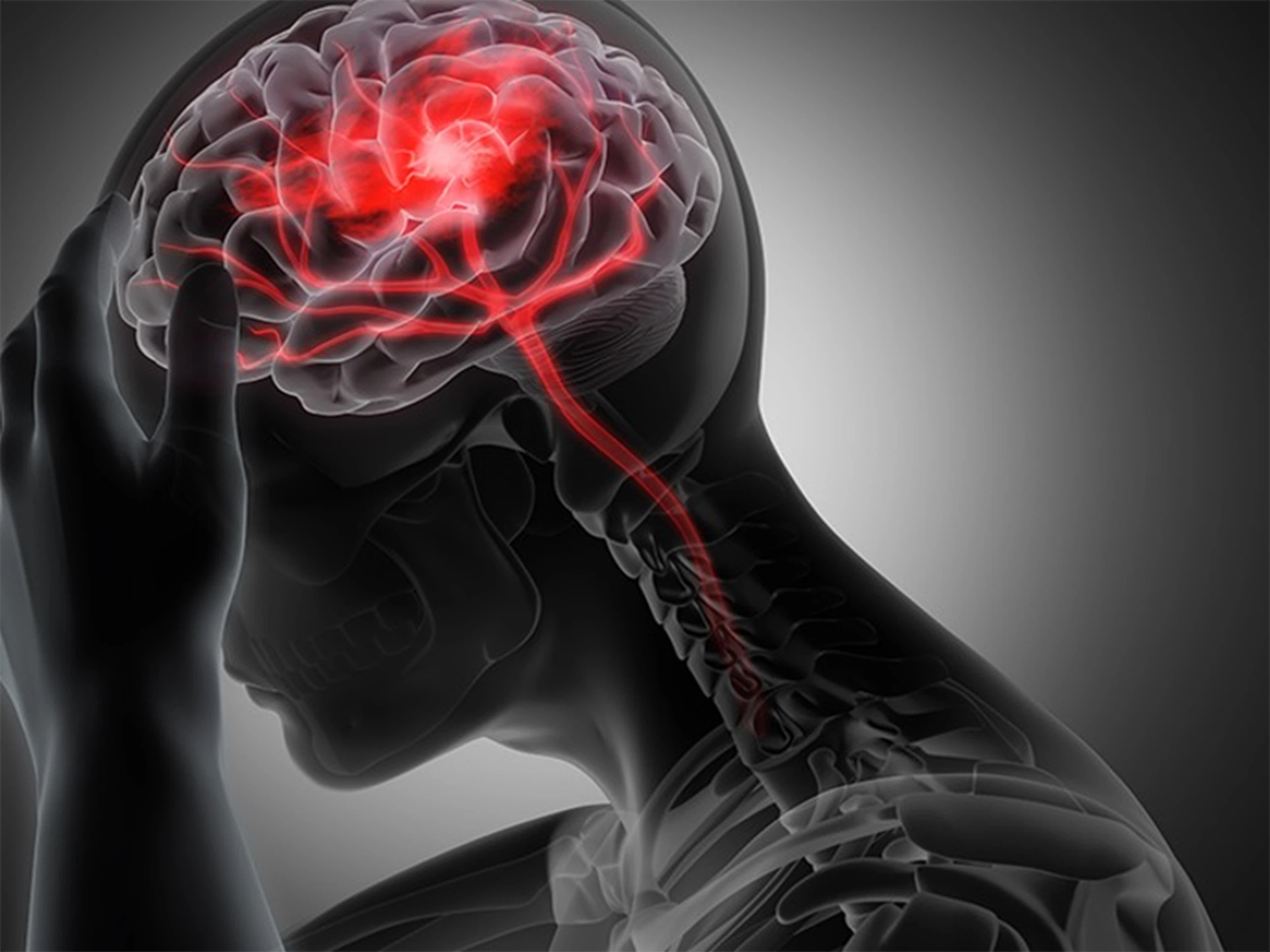 Huyết khối làm tắc nghẽn mạch máu não, khiến oxy không thể đến tế bào thần kinh, gây hoại tử não nhanh chóng
