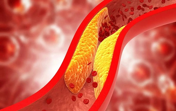 Mảng bám cholesterol bít hẹp lòng mạch, kết hợp áp lực máu cao dễ gây nứt vỡ mạch não
