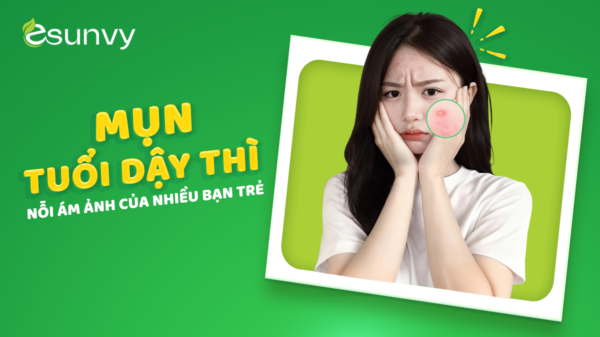 Mụn dậy thì là nỗi ám ảnh của nhiều bạn trẻ