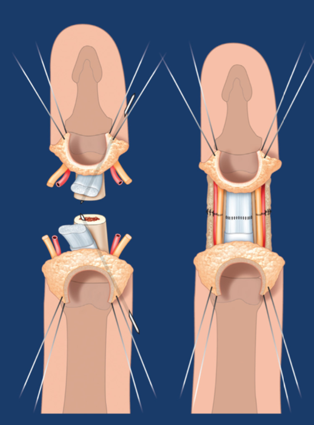 Các mạch máu và dây thần kinh được hồi phục sau vi phẫu thuật nối ngón tay