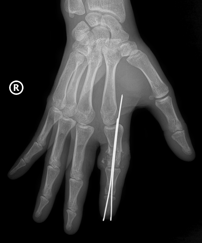 Hình ảnh X-Quang phần ngón trỏ tay phải bị đứt rời của anh D được định vị và cố định bằng kim chuyên dụng
