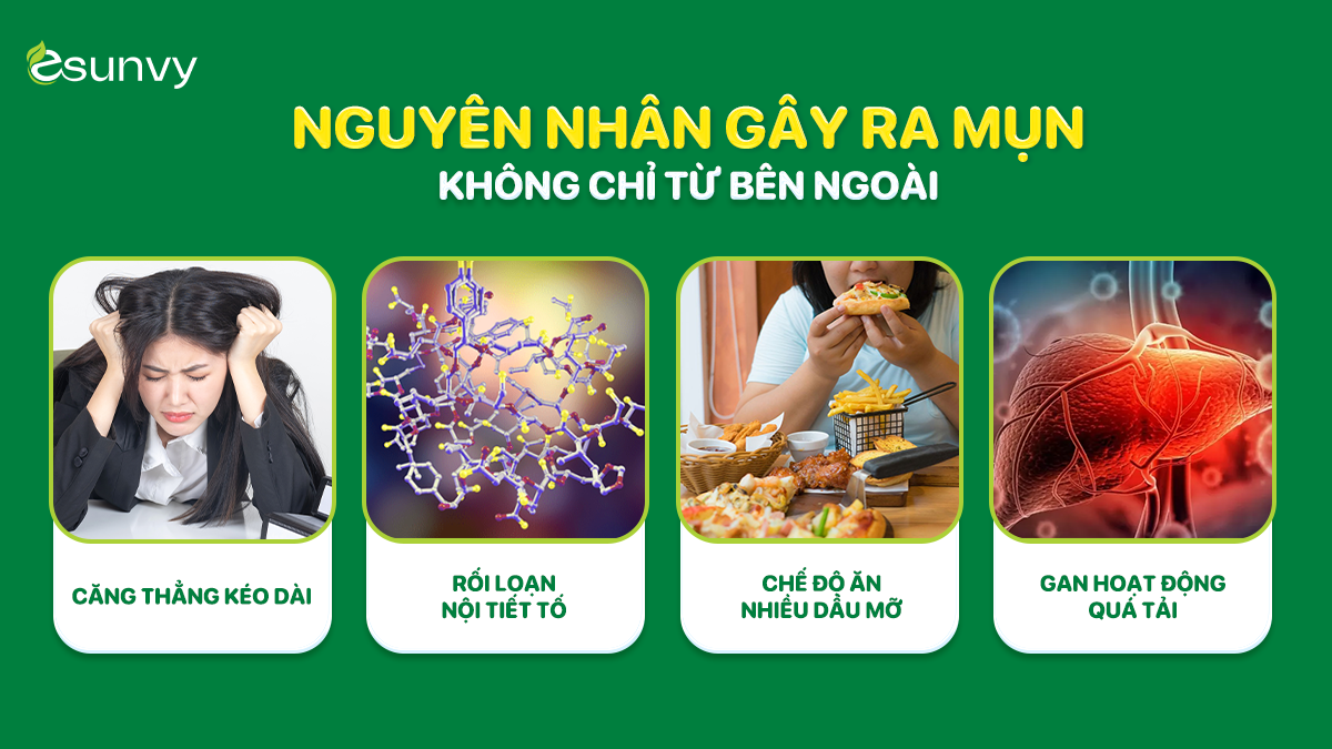 Mụn không chỉ xuất phát từ bên ngoài mà còn đến từ bên trong cơ thể