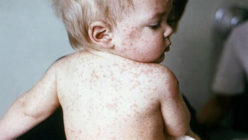 Đối tượng dễ mắc bệnh sởi nhất là trẻ nhỏ