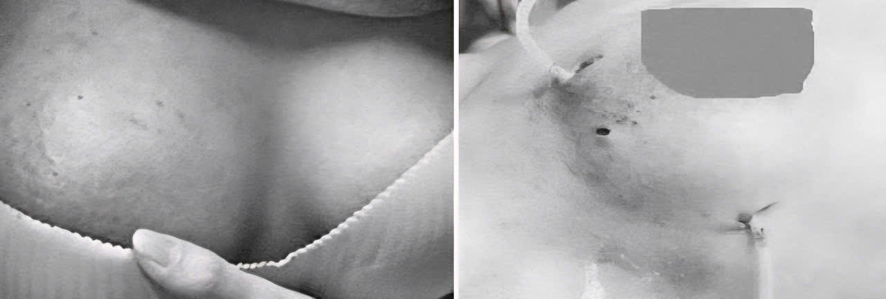 Người phụ nữ 30 tuổi bị nhiễm trùng ngực sau khi tiêm filler tại cơ sở thẩm mỹ "chui"