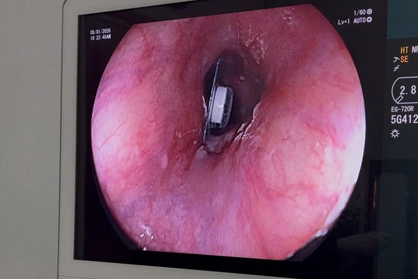 Viên thuốc còn nguyên vỏ kẹt ngang thực quản người phụ nữ