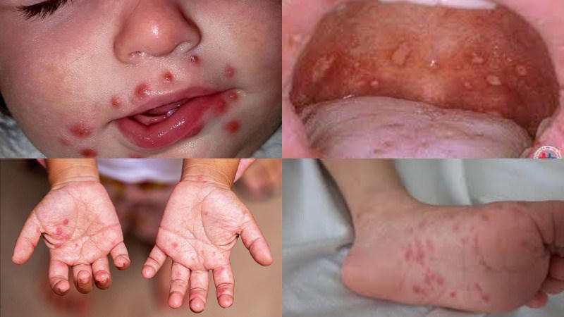 Bộ Y tế chỉ đạo xử lý các ổ dịch sốt xuất huyết, chân tay miệng tại TP. Hồ Chí Minh