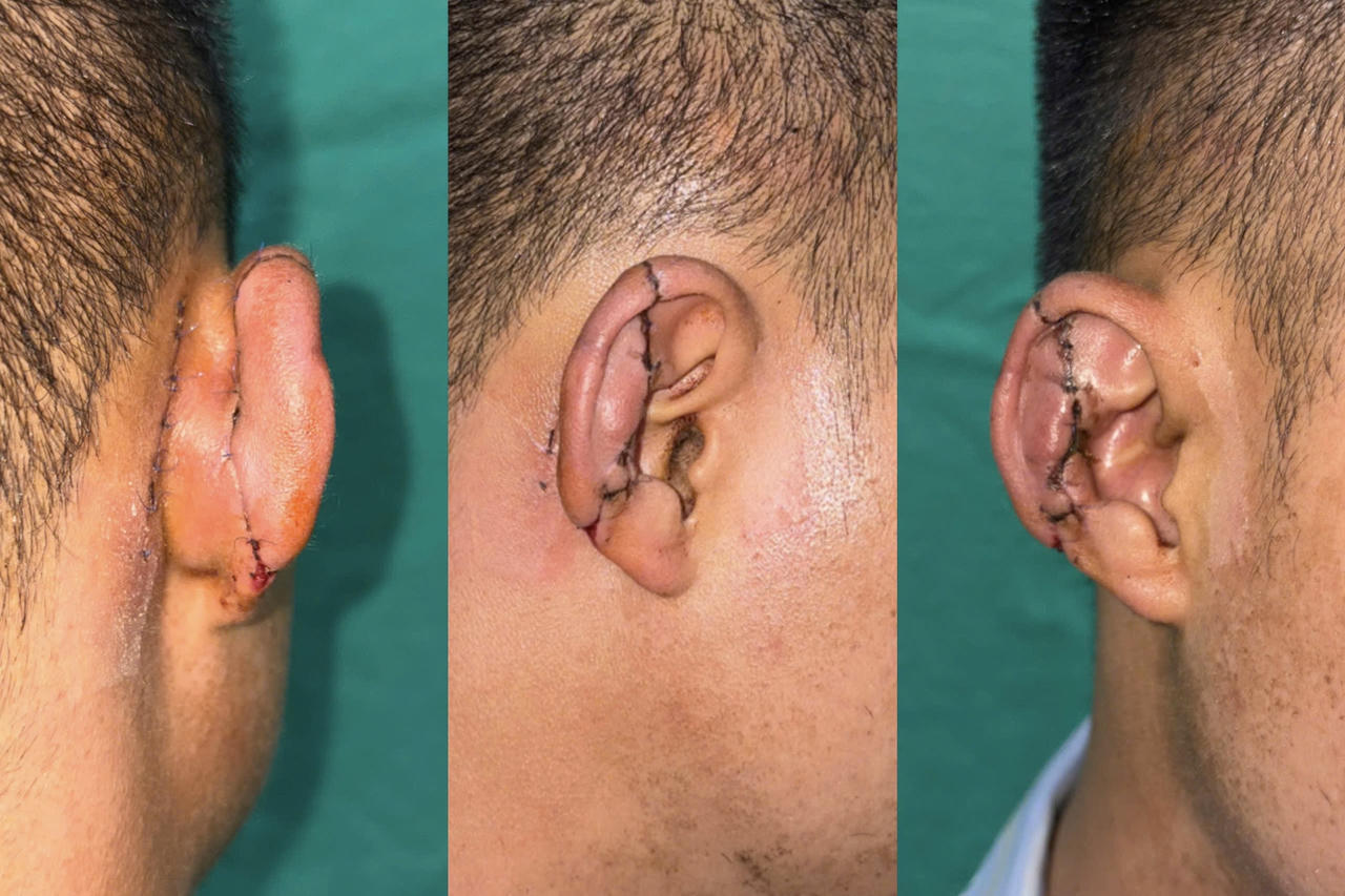 Cứu thành công vành tai gần đứt rời của bệnh nhân bị tai nạn giao thông