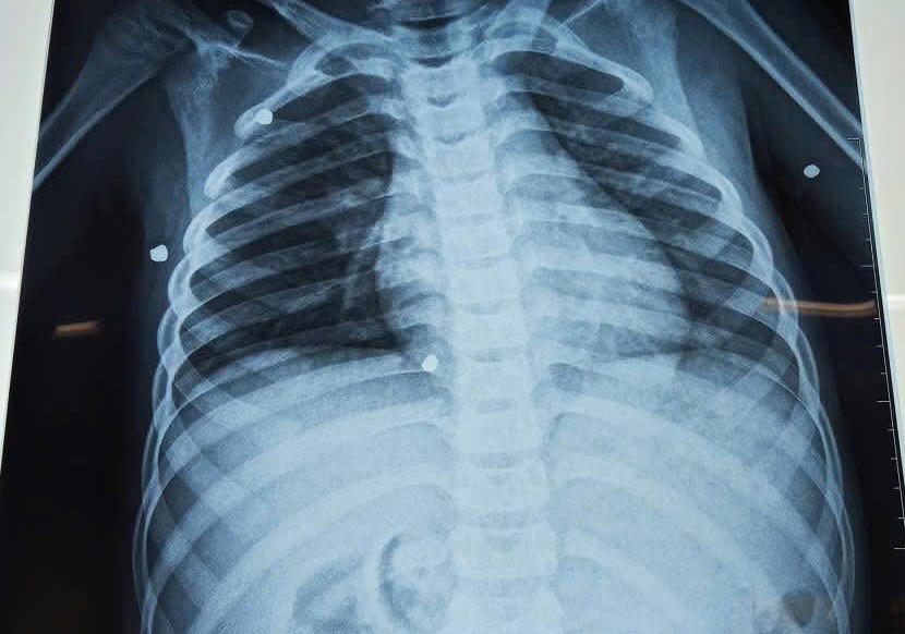 Bé trai 6 tuổi bị đa chấn thương nghiêm trọng do nghịch súng hơi