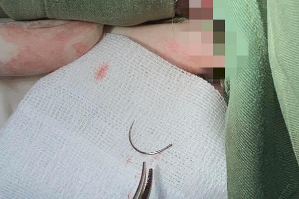 Lấy dị vật là kim khâu tồn tại 11 năm ở tầng sinh môn cho bệnh nhân