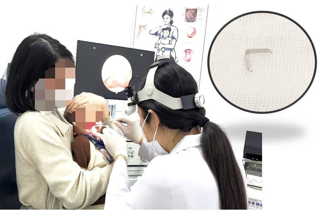 Hóc ghim tất, bé trai 12 tháng tuổi nhập viện 