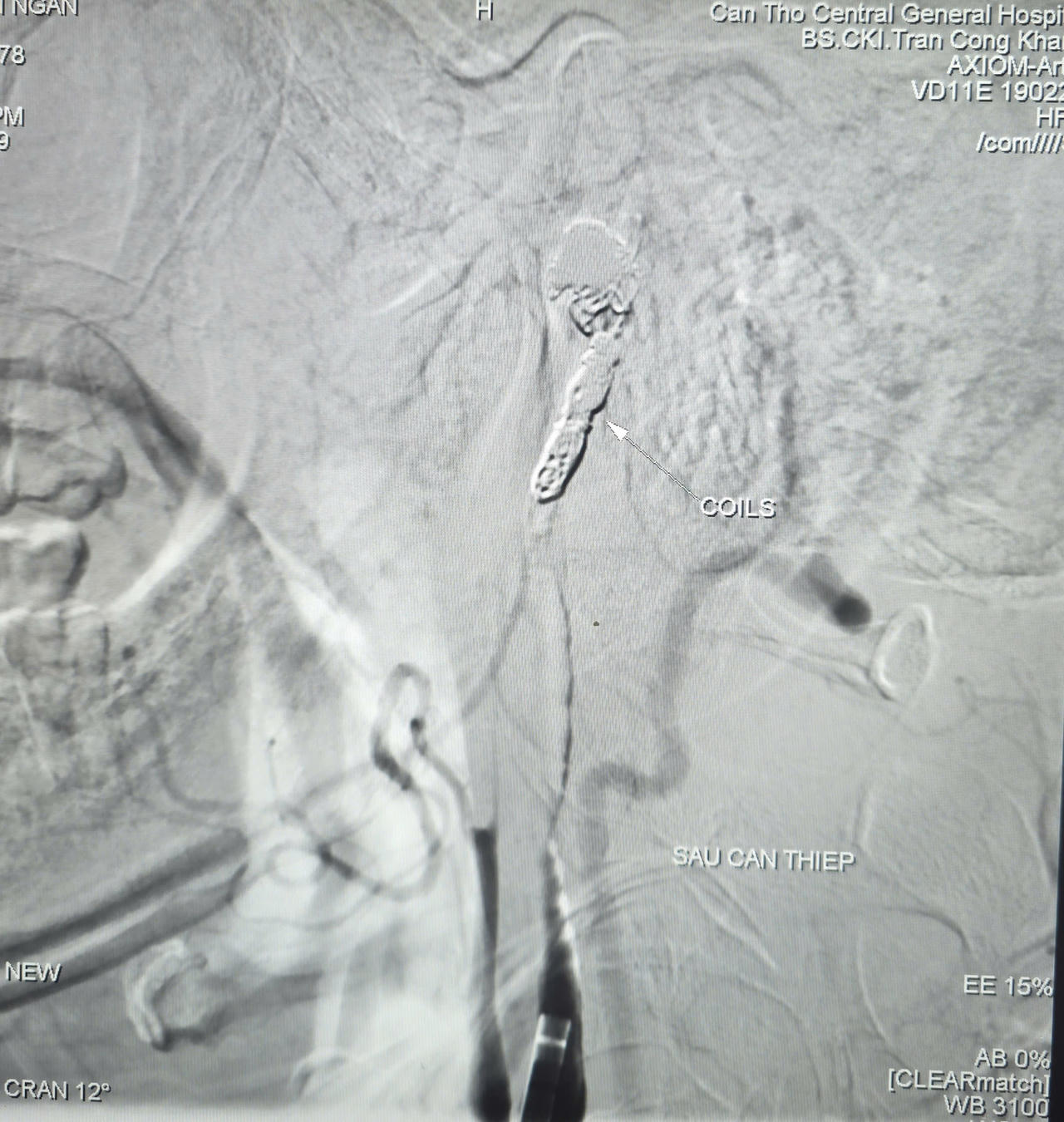 Bệnh viện Đa khoa TW Cần Thơ cứu sống bệnh nhân ung thư vòm hầu xuất huyết ồ ạt