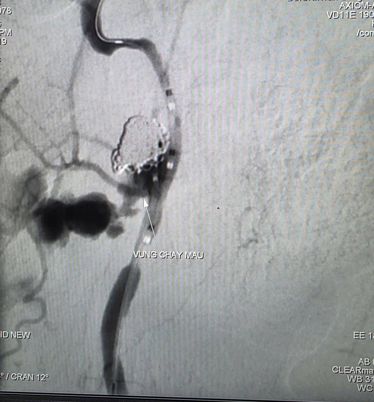 Bệnh viện Đa khoa TW Cần Thơ cứu sống bệnh nhân ung thư vòm hầu xuất huyết ồ ạt