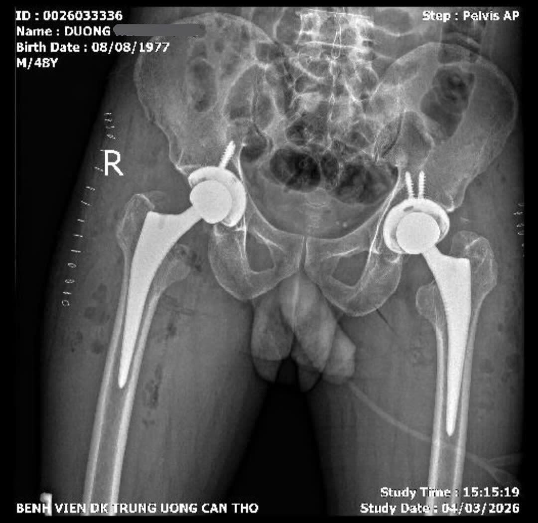 Bệnh viện Đa khoa TW Cần Thơ: Thành công thay khớp háng hai bên cùng lúc bằng kỹ thuật ít xâm lấn