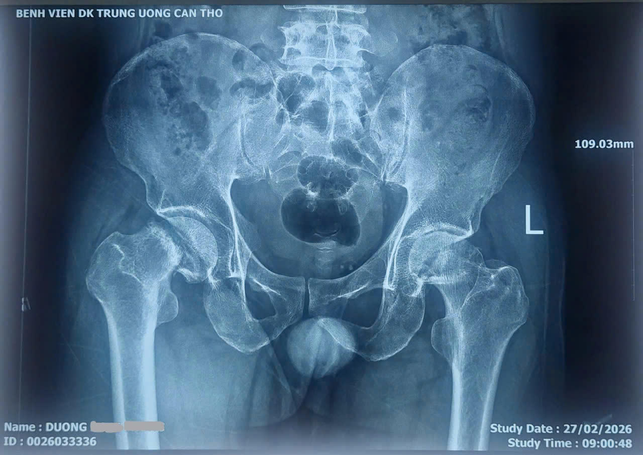 Bệnh viện Đa khoa TW Cần Thơ: Thành công thay khớp háng hai bên cùng lúc bằng kỹ thuật ít xâm lấn