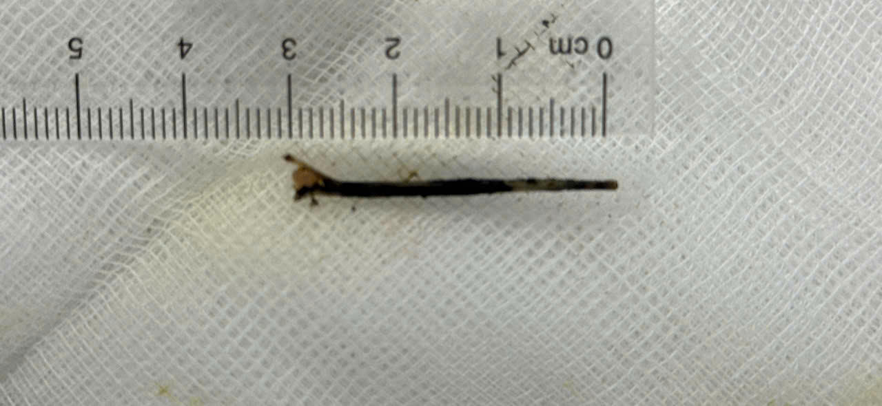 Hình ảnh xương cá được lấy ra sau can thiệp.