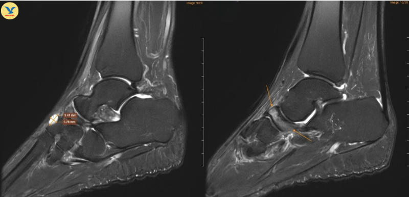 Đau khớp cổ chân khởi phát không rõ nguyên nhân, đi khám phát hiện Hội chứng Mueller-Weiss hiếm gặp