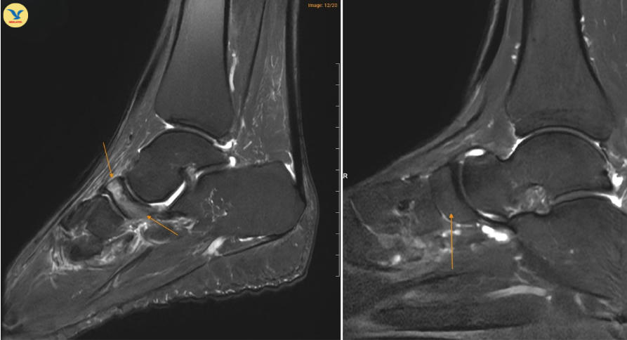 Hình ảnh MRI cho thấy xương ghe ở bệnh nhân mắc Hội chứng Müller–Weiss (bên trái) có vùng sáng hơn bất thường, trong khi xương ghe ở bàn chân bình thường (bên phải) có hình ảnh đồng nhất hơn.