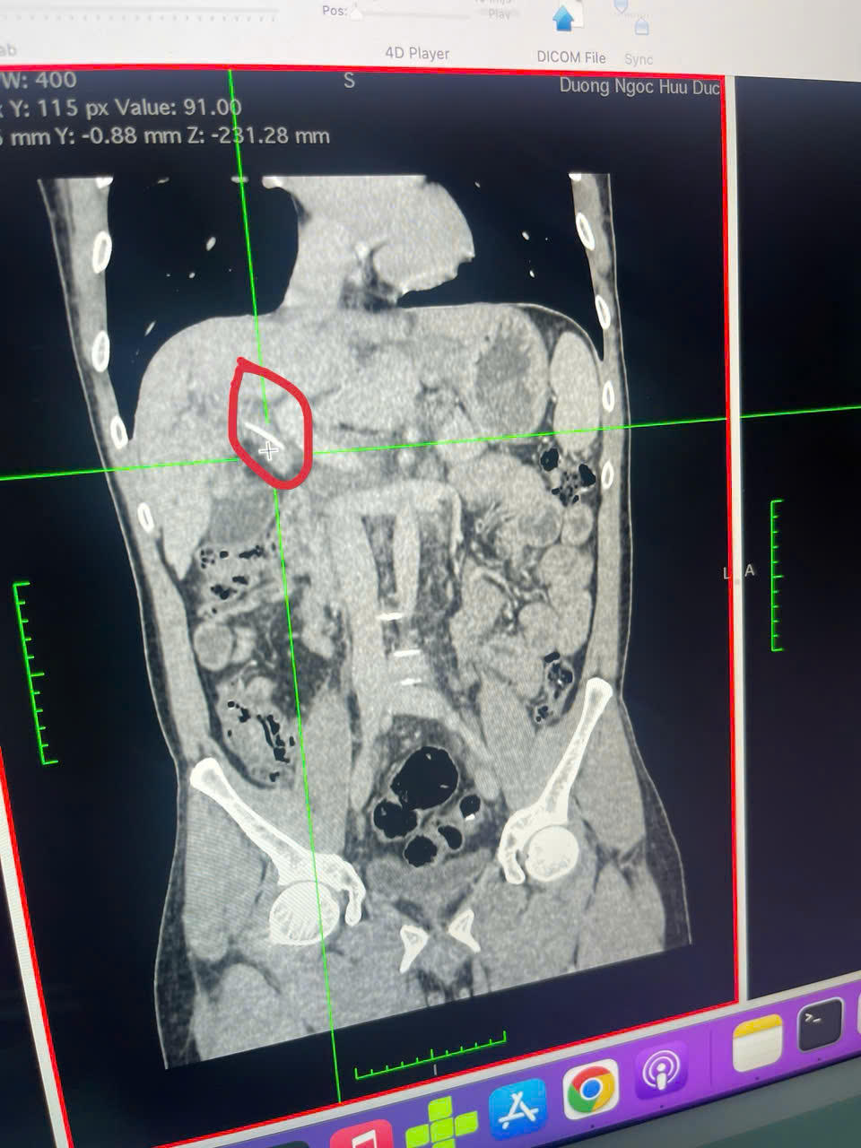 Dị vật trên phim chụp cắt lớp vi tính bụng có cản quang.