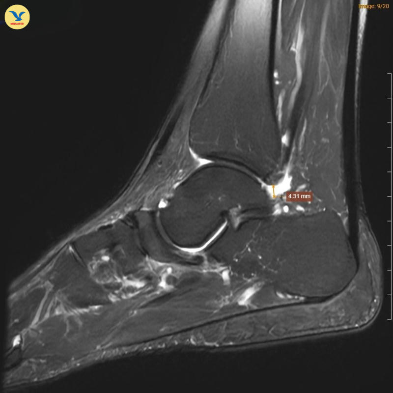 MRI chân trái ghi nhận hình ảnh thoái hóa khớp và phù nề.