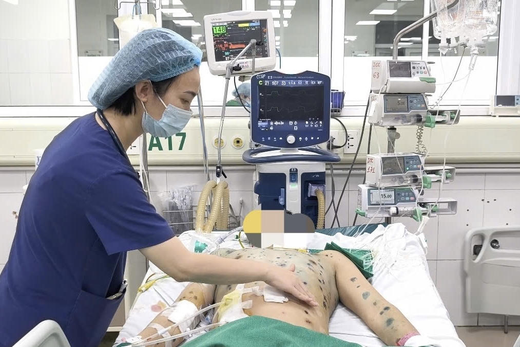 Thủy đậu ở người lớn, cẩn thận biến chứng nguy hiểm