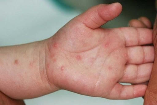 Tăng nhanh số ca tay chân miệng, 4 ca tử vong, người dân cần làm gì?