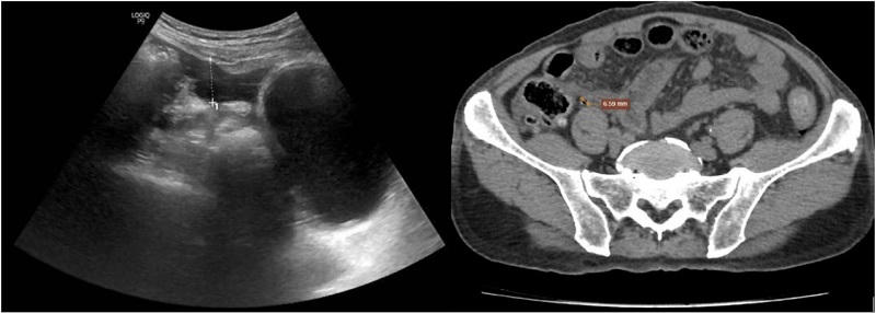 Kết quả siêu âm (bên trái) và chụp CT (bên phải) - tiêu chuẩn chẩn đoán xác định đều cho nghi ngờ thủng tạng rỗng.