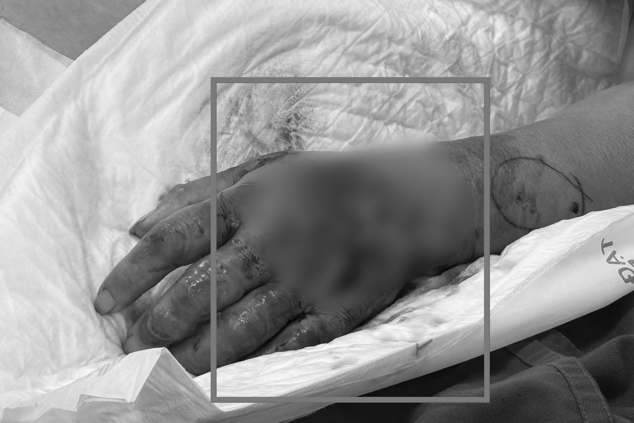 Nữ bệnh nhân sốc nhiễm khuẩn nguy kịch từ một tổn thương nhỏ bằng mũi kim