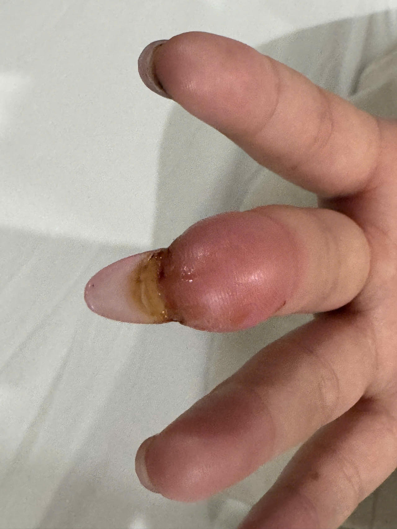 Móng tay cháu N.H.A bị bẻ lật móng gây đau nhức và liên tục chảy mủ. Ảnh: Ngọc Phúc