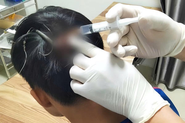 Thiếu niên 15 tuổi bị móc 3 tiêu cắm vào đỉnh đầu khi câu cá