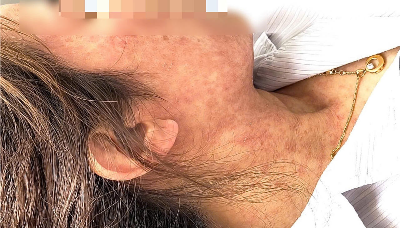 Xét nghiệm cho thấy chỉ số viêm CRP tăng cao (43,8 mg/L) và dương tính với virus sởi. Ảnh: Thanh Thanh