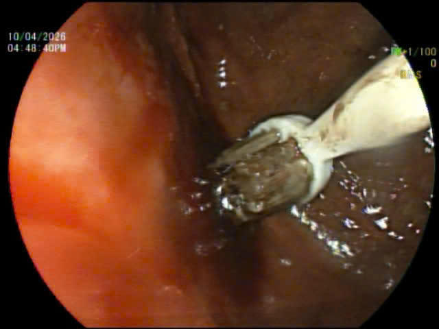 Hình ảnh&nbsp;nội soi của nam thanh niên nuốt bàn chải đánh răng.&nbsp;