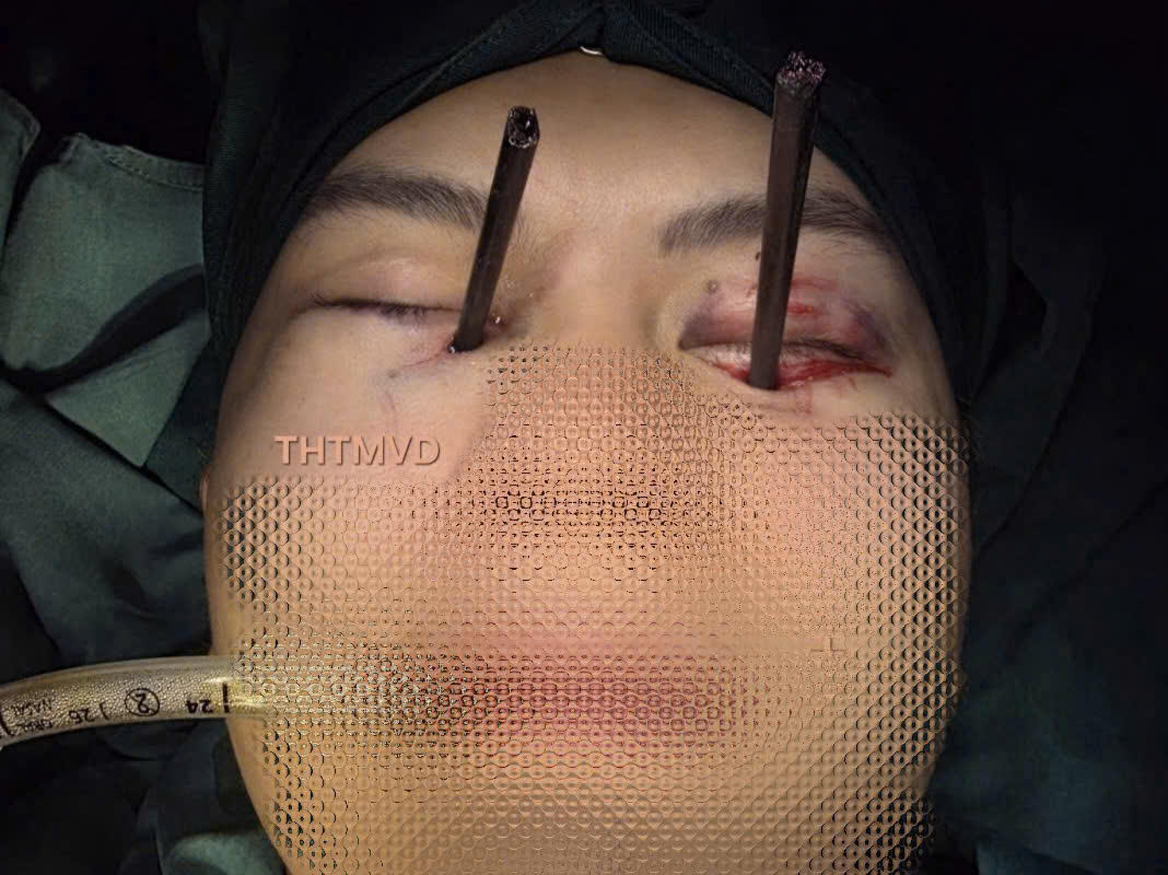 Nghẹt thở cấp cứu nam thanh niên bị 2 chiếc đũa đâm xuyên hai mắt