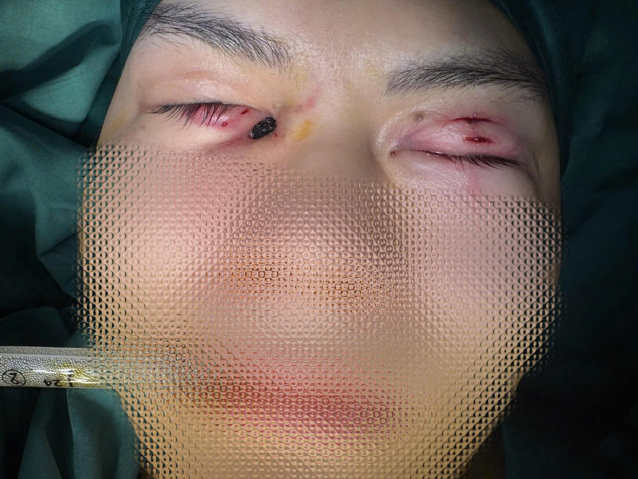 Nghẹt thở cấp cứu nam thanh niên bị 2 chiếc đũa đâm xuyên hai mắt