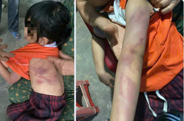 Hà Tĩnh: Một bé gái học lớp 2 bị bạn đánh nhiều vết bầm tím