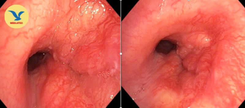 Hình ảnh nội soi phế quản: U sùi thâm nhiễm gây hẹp 1/3 dưới khí quản