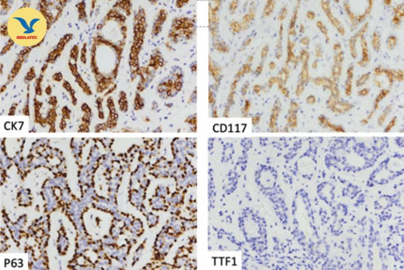 Chuyện lạ ở bệnh viện: Chuyên gia kiên trì thuyết phục bệnh nhân thực hiện sinh thiết, phát hiện ung thư phổi hiếm gặp