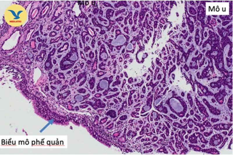 Hình ảnh vi thể xét nghiệm mô bệnh học của bệnh nhân 