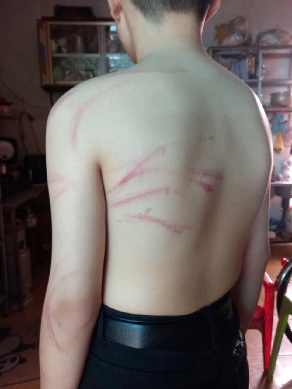 Em H.B bị trầy xước sau khi bị đánh