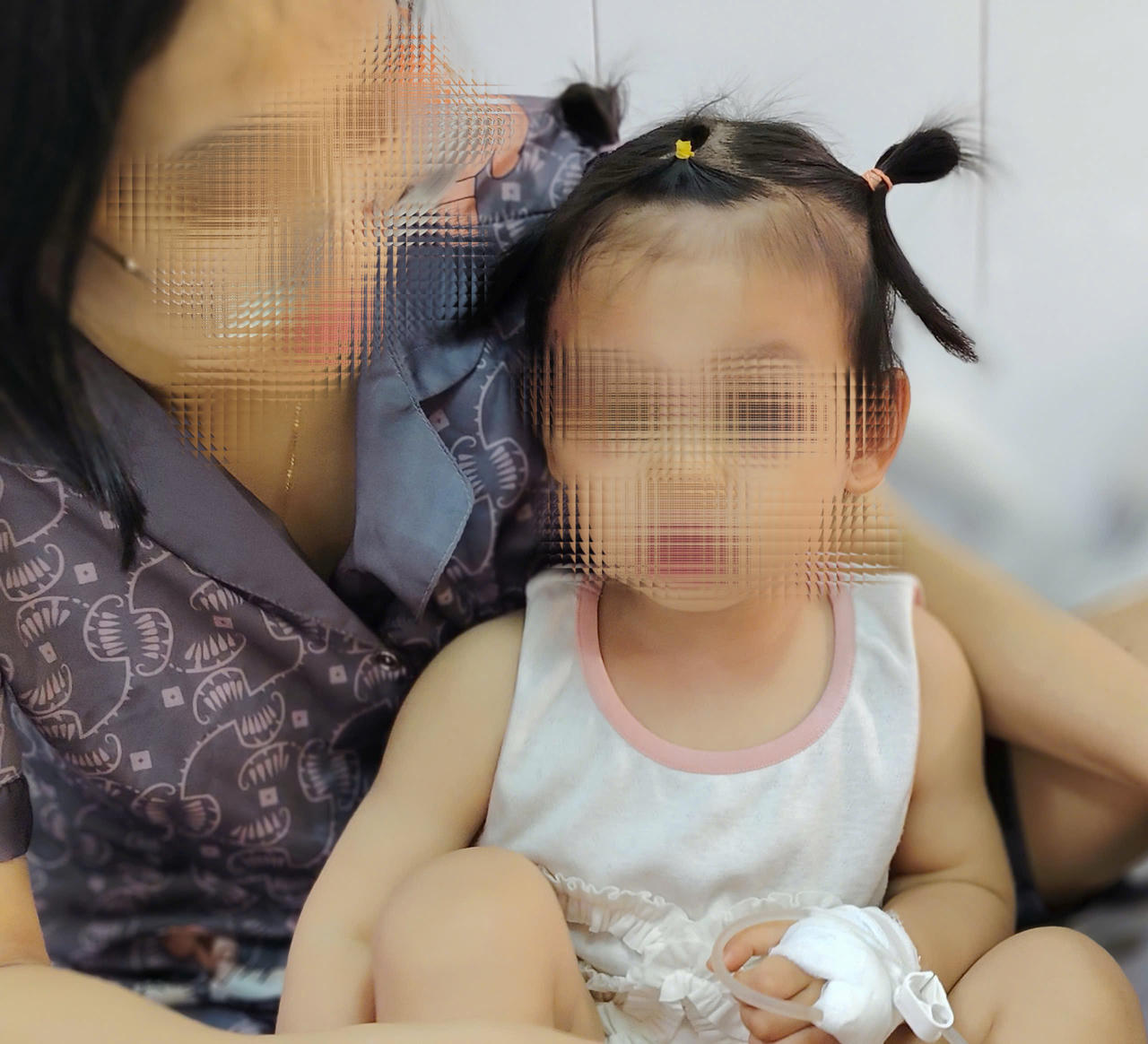 Cấp cứu kịp thời giữ lại khuôn mặt cho bé gái 22 tháng tuổi bị chó cắn