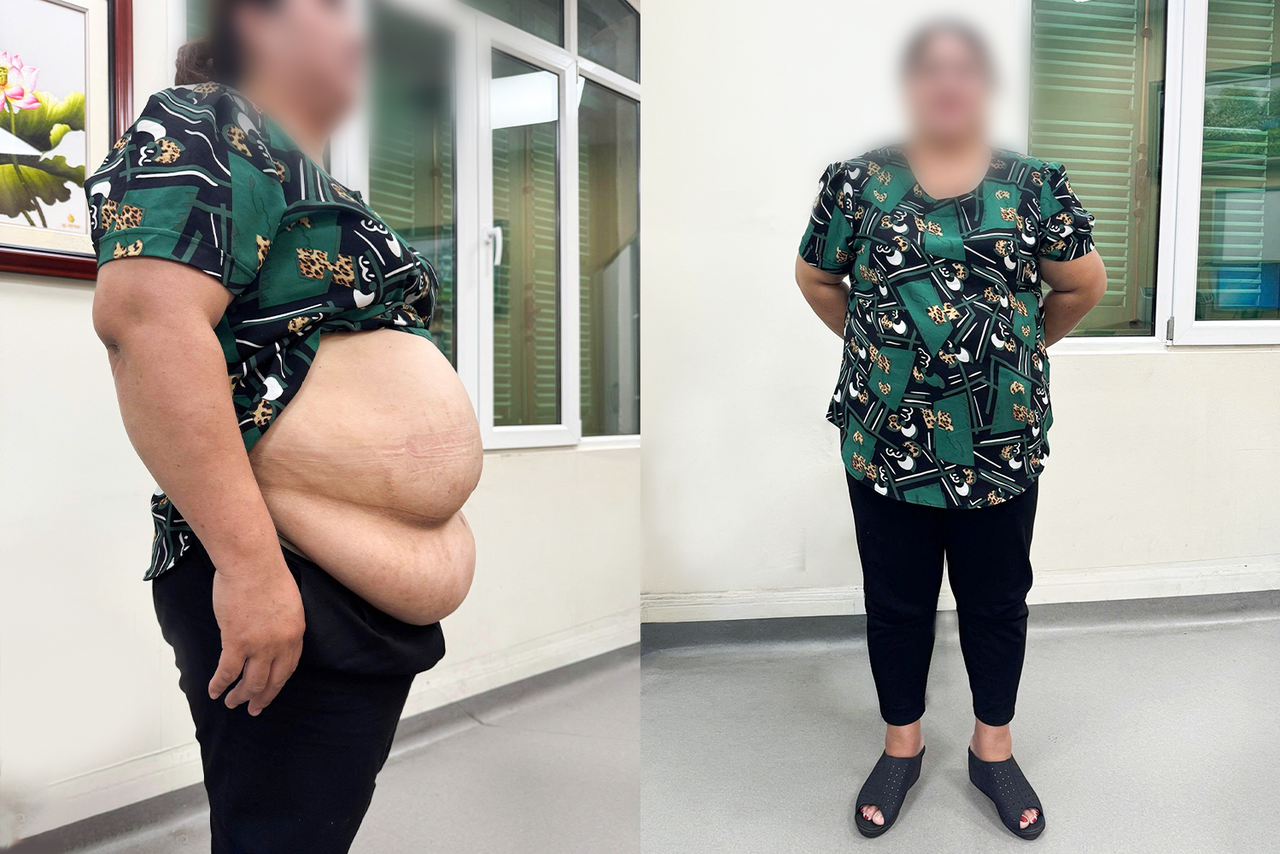 Chị N từng nặng 101kg với chỉ số BMI khoảng 37,6 - ngưỡng béo phì mức độ nặng. (Ảnh: NVCC)