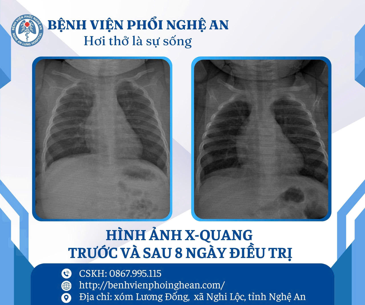 Hình ảnh X-Quang trước và sau 8 ngày điều trị tích cực.